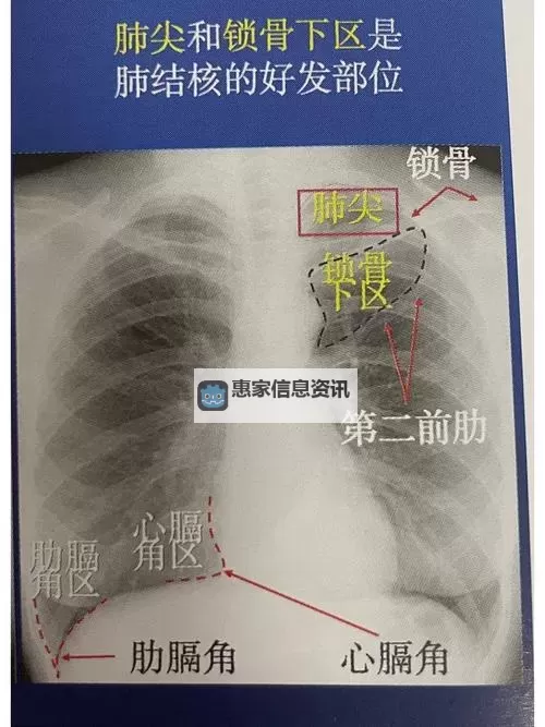 免费体验:胸片100%曝光九一优惠活动火热开启图1