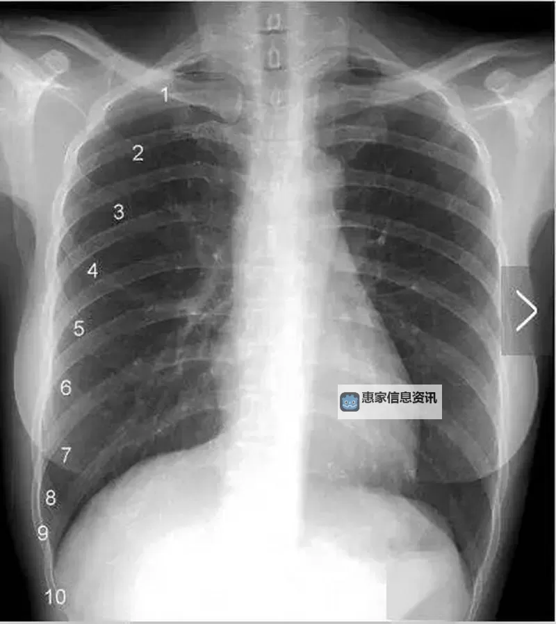 胸片曝光2020在线观看:完整版高清资源免费获取图1