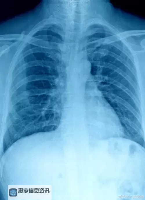 100%胸片曝光率可以直接看免费无病毒,保障您的健康无忧图1